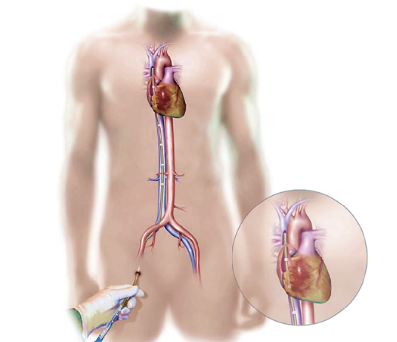 Bio-Medicus Multi-Stage