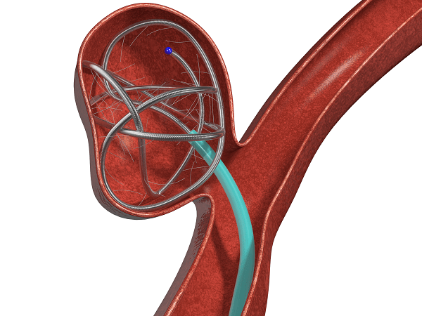 Эмболизация сосудов